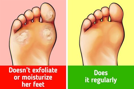 Removing Calluses From Heels, Remove Calluses On Feet Remedies, How To Remove Calluses From Foot, Heel Callus Remover Diy, How To Get Rid Of Calluses On Feet Fast, Remove Callous From Foot, Callus Remover Diy, Tinea Pedis, Best Callus Remover