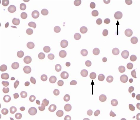 hereditary spherocytosis Hereditary Spherocytosis, Working Woman, Quick Saves