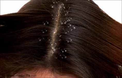 This article is all about dandruff, what causes dandruff and what you can do to treat this condition. What Is Dandruff, What Causes Dandruff, Treat Dandruff, How To Treat Dandruff, Home Remedies For Dandruff, Hair Smoothening, Remedies For Tooth Ache, Thick Hair Remedies, Dandruff Remedy