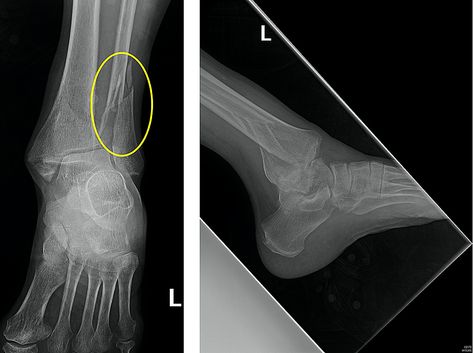 Cureus | Acute Management of Trimalleolar Fracture Trimalleolar Fracture, Broken Ankle Recovery, Open Fracture, Ankle Recovery, Ankle Fracture, Broken Ankle, Colleges In Florida, Elderly Woman, Emergency Medicine