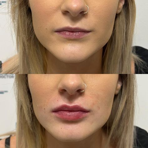 Lip Fillers On Small Lips, Small Lips With Lip Filler, Sarah Cameron Lip Filler, Natural Russian Lips, M Shape Lip Filler, Natural Lip Injections Before And After, Lip Filler On Small Mouth, Small Lips Filler, Small Lips Lip Filler