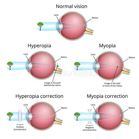 vision problems and their correction, myopia and hyperopia royalty free illustration Eye Anatomy Drawing Medical, Hyperopia Vision, Optician Training, Optometry Education, Optometry School, Learn Physics, Eye Facts, Eye Anatomy, Eye Vision