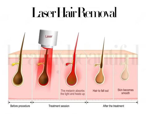 810 diode laser hair removal reviews Best Hair Removal, Diode Laser Hair Removal, Best Hair Removal Products, Beauty Science, Ipl Laser Hair Removal, Underarm Hair Removal, Hair Removal Devices, Laser Hair Removal Device, Ipl Laser