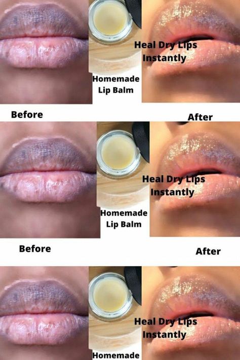 Homemade Lip Balm for Chapped Dry Lips||How to Get Rid of Very Dry LipsDIY Lip BalmHomemade Lip Balm Hello beautiful people! you're welcome back to my Channe... Brighten Lips Diy, Chapped Lips Remedy Severe, Chapped Lips Remedy, Aloe Vera For Sunburn, Remedies For Dry Mouth, Fuller Lips Naturally, Very Dry Lips, Home Remedies For Warts, Homemade Lip Balm