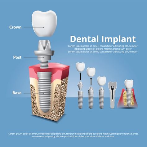 Premium Vector | Human teeth and dental implant Medicine Poster, Thank You Nurses, Medical Posters, Human Teeth, Dental Marketing, Teeth Implants, Dental Implant, Health Promotion, Dental Implants