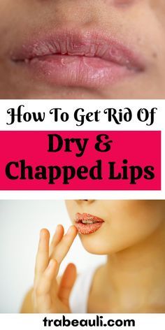 How to Get Rid of Chapped Lips in 3 Days How To Fix Chapped Lips, Dry Cracked Lips Remedy, How To Keep Lips Moisturized, How To Fix Dry Lips, How To Get Rid Of Chapped Lips, Chapped Lips Remedy Severe, Dry Lips Remedy Overnight, Get Rid Of Dry Lips, Dry Lips Remedy