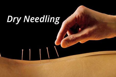 Your Top 6 Dry Needling Questions Answered - Needling Therapy, Dry Needling Therapy, Neck Sprain, Remedial Massage, Acupuncture Needles, Dry Needling, Sports Therapy, Neck Lines, Best Massage