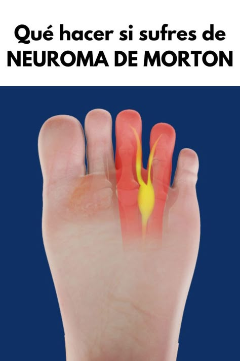 NEUROMA DE MORTON Facitis Plantar, Morton's Neuroma, Medicine Notes, Musculoskeletal System, Dr House, God Loves Me, Sciatica, Skin Problems, Beauty Secrets