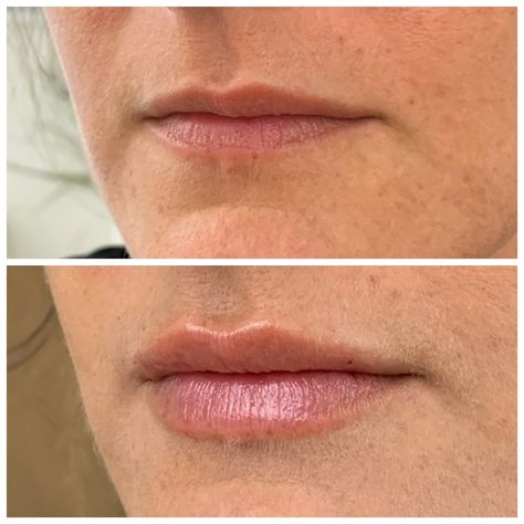 Lip Filler For Small Lips, Small Lip Injections, Small Lips Lip Filler, Lip Filler Before And After Small Lips, Lip Threading Before And After, Natural Lip Fillers Small Lips, Natural Lip Fillers 0.5ml, Lip Filler On Small Lips, Subtle Lip Filler Before And After