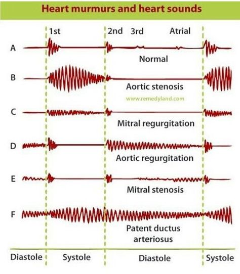 Patent Ductus Arteriosus, Heart Diagram, Heart Sounds, Pa School, Platelet Rich Plasma, Best Nursing Schools, Instagram Heart, Lpn Nursing, Aesthetic Medicine