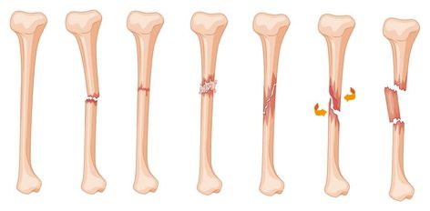 Leg Fracture, Open Fracture, Types Of Fractures, Soft Tissue Injury, Bone Fracture, Pulmonology, Bone Diseases, Magnetic Resonance Imaging, Medication Management