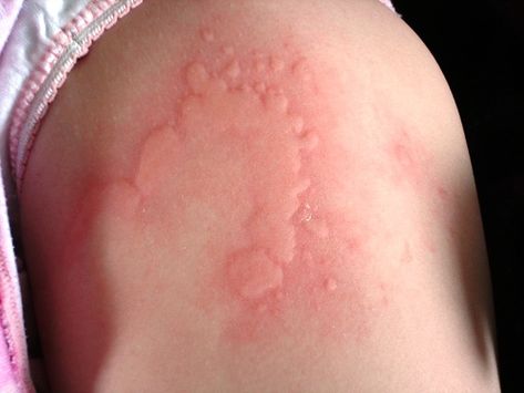 Allergy Hives, Skin Allergy, Allergy Symptoms, Body Hacks, Skin Allergies, Natural Medicine, Skin Conditions, Health Remedies, Natural Healing