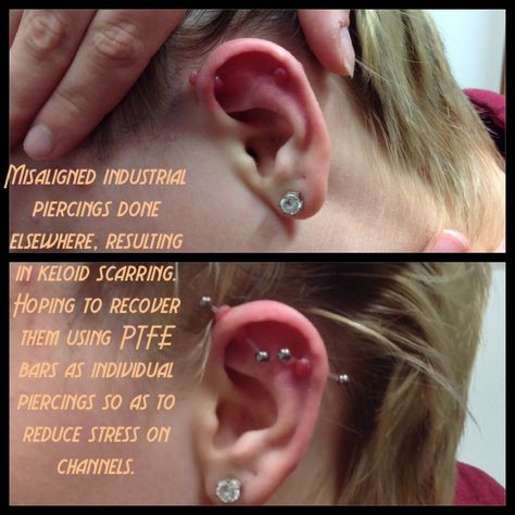 Industrial piercing done elsewhere that I am trying to resolve. Original channels misaligned so placing stress on each other with the bar. Keloid scarring is the result in this case. Hopefully PTFE bar may enable the scarring to reduce but there are no guarantees. Should be a bit less painful and angry soon though. Recommended visit yo doctor as infection definitely present. Correct aftercare guidance given as well. Industrial Piercing Infected, Piercing Bump, Piercing Aftercare, Industrial Piercing, Cosmetic Tattoo, Body Is A Temple, Scarring, I Am Trying, Gifts For Photographers