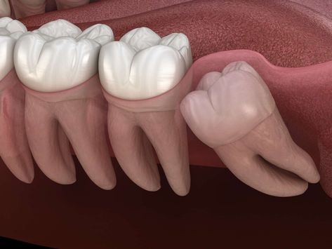 Wisdom Teeth Recovery, Impacted Wisdom Teeth, Teeth Surgery, Impacted Tooth, Gum Surgery, Dental Extraction, Wisdom Tooth Extraction, Wisdom Teeth Removal, Dental Emergency