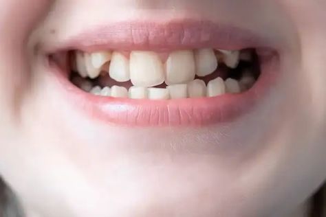 Do you hate the way your teeth look? Your teeth are an integral part of your smile and… The post Why Are My Teeth Crooked? What Causes Crooked Teeth? appeared first on Florida Independent 🌈. Deep Teeth Cleaning, Smile Tips, Teeth Aesthetic, Crooked Smile, Dental Health Care, Crooked Teeth, Loose Tooth, Perfect Teeth, Smile Teeth