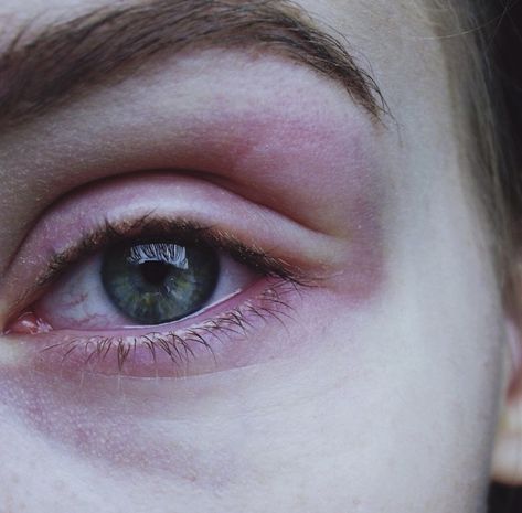 red swollen painful eye after allergic reaktion, green eyecolor, pale skin Vampire Pale Skin, Swollen Eye, Travis Phelps, Brain Juice, Novel Aesthetic, Swollen Eyes, Eyeball Art, Irritated Eye, Pale Face