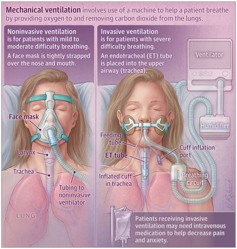 Mechanical Ventilation Respiratory, Mechanical Ventilation Nursing, Osce Exam, Ventilator Modes, Respiratory Therapy Student, Nurse Skills, Nurse Notes, Nursing School Essential, Nursing School Motivation