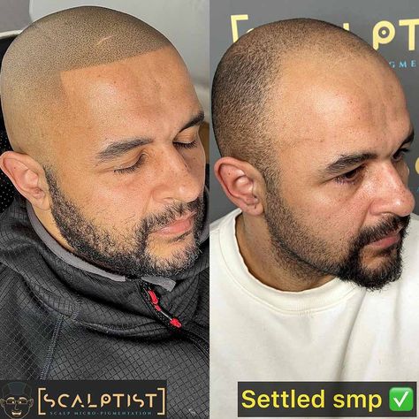 Microblading For Men, Scalp Micropigmentation Women, Micro Pigmentation, Underlying Pigment Hair Chart, Micro Scalp Pigmentation, Microblading Healing Stages, Hairtransplant Men, Scalp Tattoo, Scalp Micropigmentation