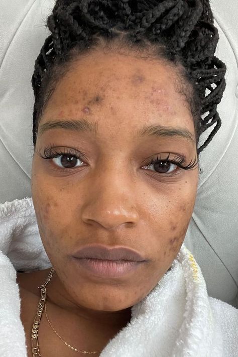 Girl With Acne, Cystic Ovarian Syndrome, Lemon Face Mask, Pimples Under The Skin, Keke Palmer, Popsugar Beauty, Bare Face, Beauty Standards, Body Positivity