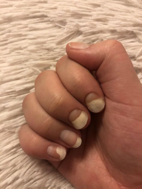 Just warning that gel nails done wrong can do this to your nails. ALWAYS go to a professional. #nail #nailart #nails #beauty Nails Done, You Nailed It, Gel Nails, Nail Art, Tattoos, Nails, Beauty, Nail Arts