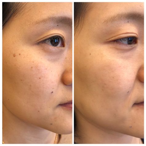 Newest and Best Lasers for Asian Skin: How to treat Hyperpigmentation and erase sun damage –  Anna Avaliani MD – Cosmetic & Laser Surgery Sun Spots Removal, Repair Sun Damaged Skin, Damaged Skin Repair, Bleaching Cream, Fractional Laser, Treating Hyperpigmentation, Laser Surgery, Skin Collagen, Dark Spots On Face