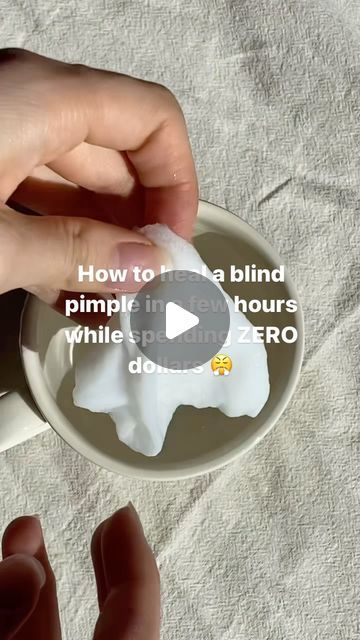 How To Prevent Pimples Skin Care, What Ur Pimples Mean, How To Pop A Pimple With A Q Tip, What Do Your Pimples Mean, How To Get Rid Of Blind Pimples, Rash Care, Hydrogen Peroxide Acne, Washing Your Face, Blind Pimple