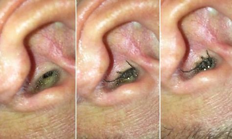 Man feels a blockage in his ear canal and discovers it's a huge spider Swimming In A Lake, Embroidery Feather, Eyebrow Tattoos, Inside Ear, Huge Spiders, Ear Ache, Best Hair Removal Products, Feather Touch, Ear Canal