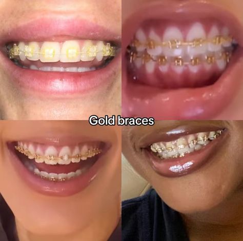 Orange Braces, Perfect Teeth Braces, Teeth After Braces, Power Chain Braces, Pink Braces, Red Braces, Gold Braces, After Braces, Cute Braces Colors