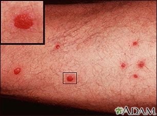 Parasites Found In Humans | itch is caused by parasites found in contaminated water the parasite ... Red Spots On Skin, Red Skin Spots, Spots On Skin, Lichen Planus, Red Rash, Itchy Rash, Parasite Cleanse, Acne Vulgaris, Contaminated Water