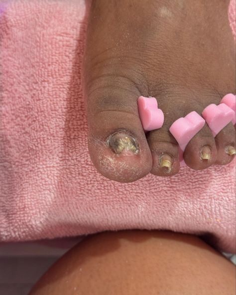 Toe BBL Loading 🐄🤍 Swipe ………..➡️➡️➡️➡️➡️ #pedicure #nailtech #toetech #chicagonails #Chicagopedicure #god #privatenailtech #smallbusiness #nailtech #chicagonailtech #polygeltech #nailtutorial #polygeltutorial #fungus #funguspedicure #nochipmanicure #polygelnails #vacationnails #gelmanicure #chicago #toereconstruction #toebbl #viral #nailtutorial #westsidetech #acrylictoes No Chip Manicure, Acrylic Toes, Polygel Nails, Vacation Nails, Nail Technician, West Side, Nail Tutorials, Gel Manicure, Nail Tech