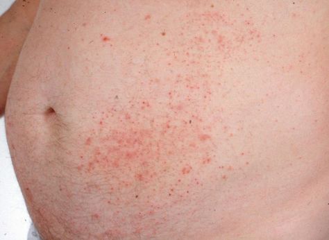 How to Find Out for Sure If Your Itchy Rash Is Caused by Gluten Dermitis Herpetiformis, Gluten Rash Pictures, Contact Dermitis Rash, Gluten Allergy Rash, Rash On Stomach, Allergy Rash, Gluten Intolerance Symptoms, Body Rash, Natural Remedies For Migraines