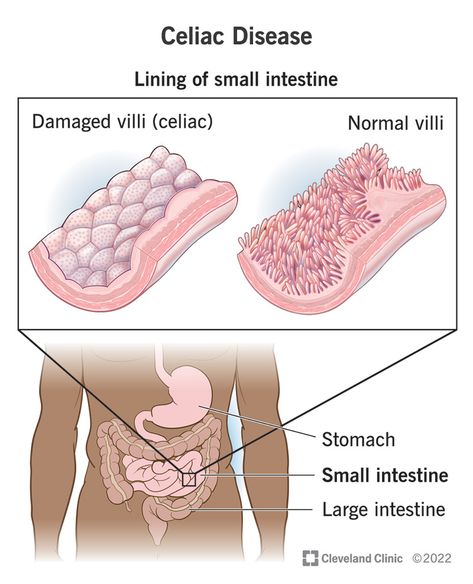 Celiac Disease: Symptoms & How It's Treated Celiac Symptoms, Hospital Medicine, Loss Of Appetite, Healthy Heart Tips, Gluten Free Kitchen, Coeliac Disease, Airway Management, Gastrointestinal System, Small Intestine