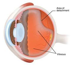 Great information about Retinal Detachment.... Newman Eye Center 602-788-8080 Posterior Vitreous Detachment, Eye Retina, Laser Vision Correction, Eye Center, Laser Clinics, Blind Eyes, Vision Problems, Eye Health, Eye Care