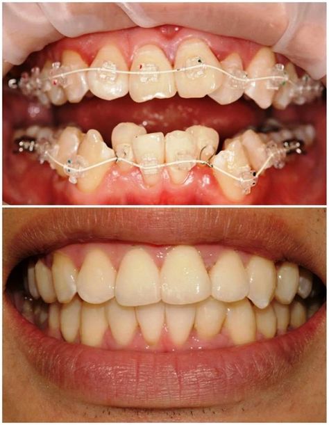 Orthodontist Practices - http://www.government-online.co.uk/boost-confidence-with-invisalign/ Dental Assistant Humor, Braces Before And After, Dental Orthodontics, Enid Oklahoma, Dental Spa, Orthodontic Appliances, Dental Facts, Dental Tourism, Dental Life