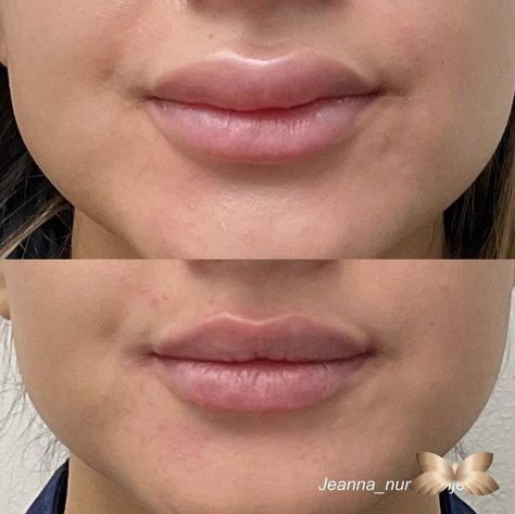 When Lip Filler Goes Bad, Can You Dissolve it? Bad Lip Injections, Plastic Surgery Gone Wrong, Facial Fillers, Lip Filler, Celebrity Plastic Surgery, Lip Injections, Lip Fillers, Plastic Surgery, Beauty Blog