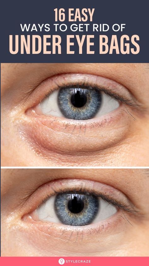 Dry Eye Remedies, Undereye Bags Remedy, Get Rid Of Eye Bags, Rid Of Eye Bags, Eye Bag Remedies, Eye Health Remedies, Puffy Eyes Remedy, Remove Eye Bags, Under Eyes