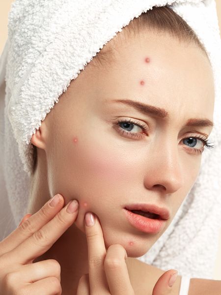 Scar Remedies, Cosmetic Fillers, Teenage Acne, Acne Products, Botox Cosmetic, Acne Overnight, Face Cream Best, Acne Skincare Routine, How To Get Rid Of Pimples