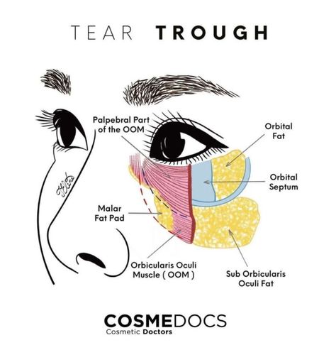 Tear Trough Filler, Face Plastic Surgery, Under Eye Hollows, Skin Anatomy, Under Eye Fillers, Face Fillers, Tear Trough, Tears In Eyes, Face Anatomy