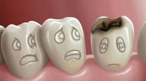 Home Remedies For Cavities, Remineralize Teeth, Tooth Infection, Heal Cavities, Dental Cavities, Tooth Pain, Tooth Sensitivity, Tooth Extraction, Oil Pulling