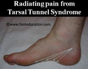 pain occurs because tarsal tunnel syndrome affects the tibial nerve or its branches as they course under tight structures with limited space along the inner Tibial Nerve, Tarsal Tunnel, Nerve Pain Remedies, Nerve Conduction Study, Foot Exercises, Nerve Health, Ankle Pain, Nerve Pain Relief, Decrease Inflammation