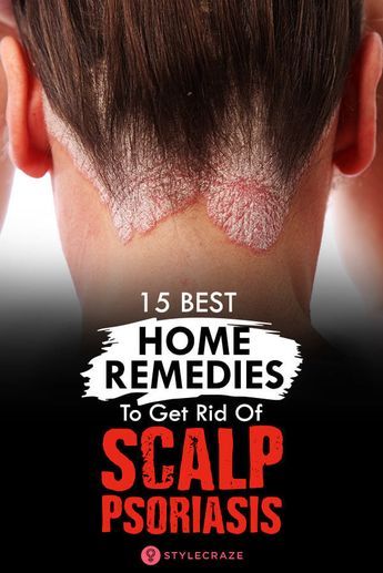 Skin Remedies, Skin Diseases, Dry Scalp, Natural Treatments, Skin Problems, Doterra, Home Remedies, Natural Remedies, Best Home