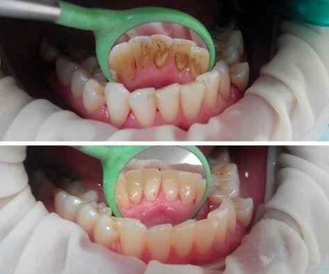 Baking Drawing, Good Teeth, Dental Hygiene Student, Dental Social Media, Dental Hygiene School, Dentistry Student, Dental Facts, Dental Design, Dental Braces