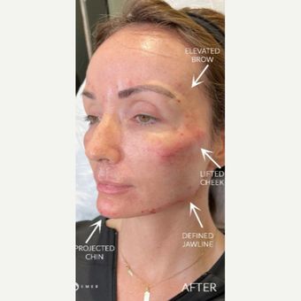 Lower Face Lift, Full Face Threading, Thread Lift Face, Mini Face Lift, Facelift Before And After, Liquid Facelift, Face Threading, Face Lift Tape, Eyebrow Lift