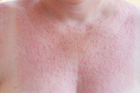 Sun poisoning: Here's what you need to know about the brutal allergy Sun Poisoning, Sun Poisoning Rash, Gluten Allergy Rash, Essential Oils For Itchy Rash, Treating Heat Rash, Allergy Rash, Body Rash, Rash Causes, Sun Allergy