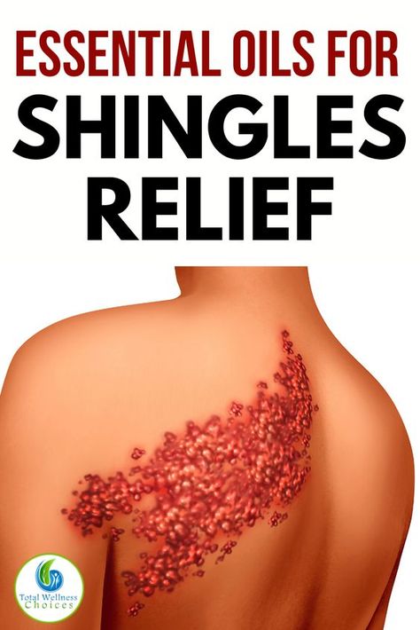 Essential Oils Shingles, Natural Remedy For Shingles, Essential Oils For Shingles Doterra, Natural Shingles Remedies, Natural Remedies For Shingles, Shingles Essential Oils, Oils For Shingles, Shingles Pain Relief, Shingles Remedies