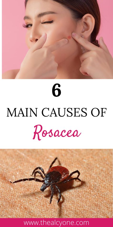 Skincare For Rocesea, Rosatia Remedies, Skin Redness Remedies, Roscea Help, Redness Remedy, Face Redness, Redness On Face, Son's Quotes, Forehead Acne