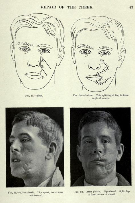 WWI -Plastic Surgery of War Wounds by Howard Gillies, 1920, via archive.org Henry Tonks, Facial Reconstruction Surgery, Antique Oddities, Facial Reconstruction, Facial Scars, Prosthetic Makeup, Ww2 Soldiers, Internal Organs, Reconstructive Surgery