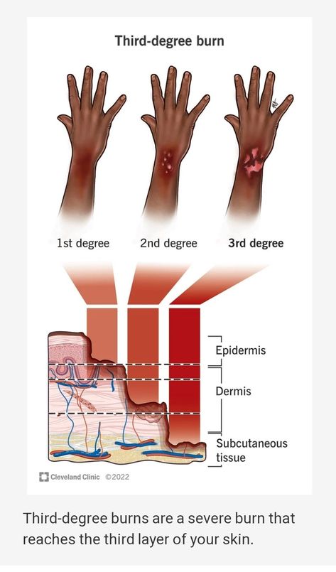 1st Degree Burns, Burns Nursing Cheat Sheet, Second Degree Burn, First Aid Burn Care, 3rd Degree Burns, Nursing Knowledge, Degree Burns, Severe Burns, Subcutaneous Tissue