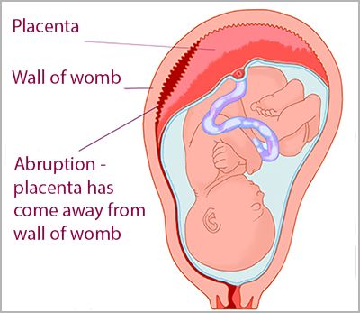 plancental abruption diagram Pregnancy Information, Romance Authors, Support System, During Pregnancy, Health Problems, Award Winning, Medical, Writing, Health