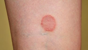 Skin Rashes Pictures, Skin Disease Pictures, Blood Blister, Fungal Infection Skin, Fungal Nail, Fungal Infection, Skin Disorders, Skin Diseases, Itchy Skin